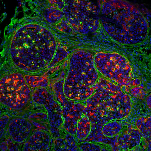 Breast tumour stained for DAPI (blue), actin (red) and fibronectin (green).