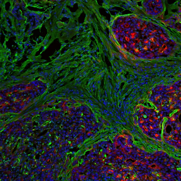 Breast tumour stained for DAPI (blue), actin (red) and fibronectin (green).
