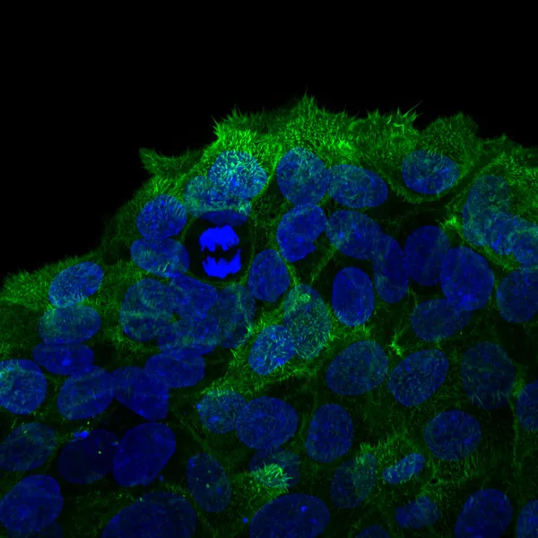 Breast cancer cells invading through collagen. The actin cytoskeleton (green) and the nuclei (blue) are labelled.