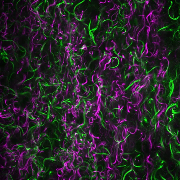 Curly collagen (green and magenta) found in the proximity of a breast tumour.