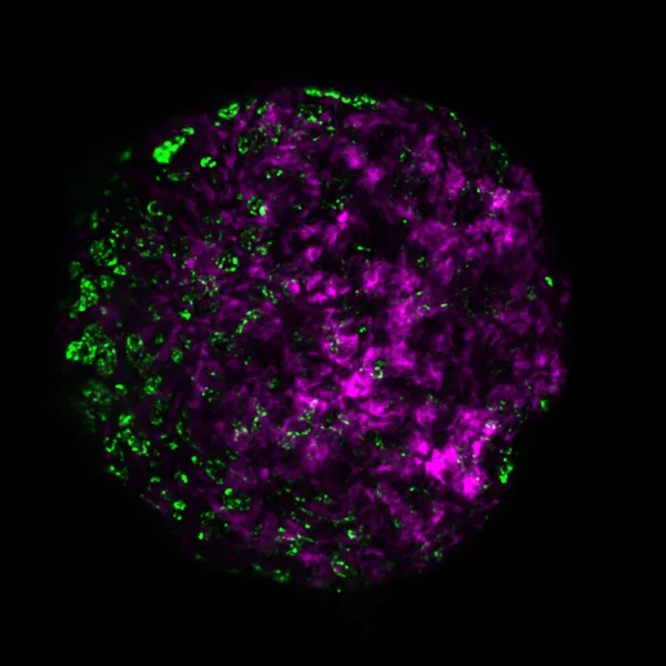 Cancer cell spheroid stained for actin (magenta) and collagen (green).