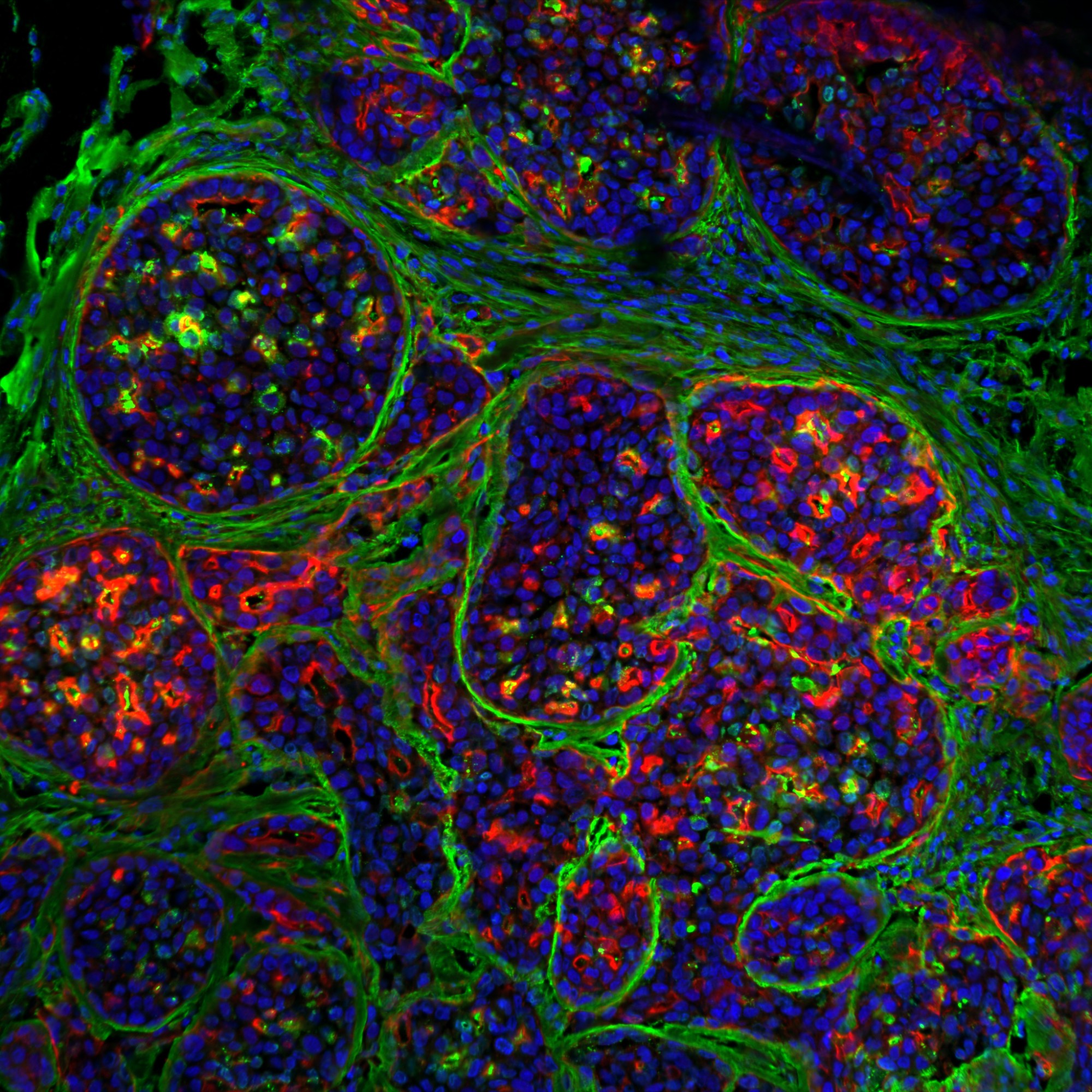 Breast tumour stained for DAPI (blue), actin (red) and fibronectin (green). Credit: Emilia Peuhu and Guillaume Jacquemet.
