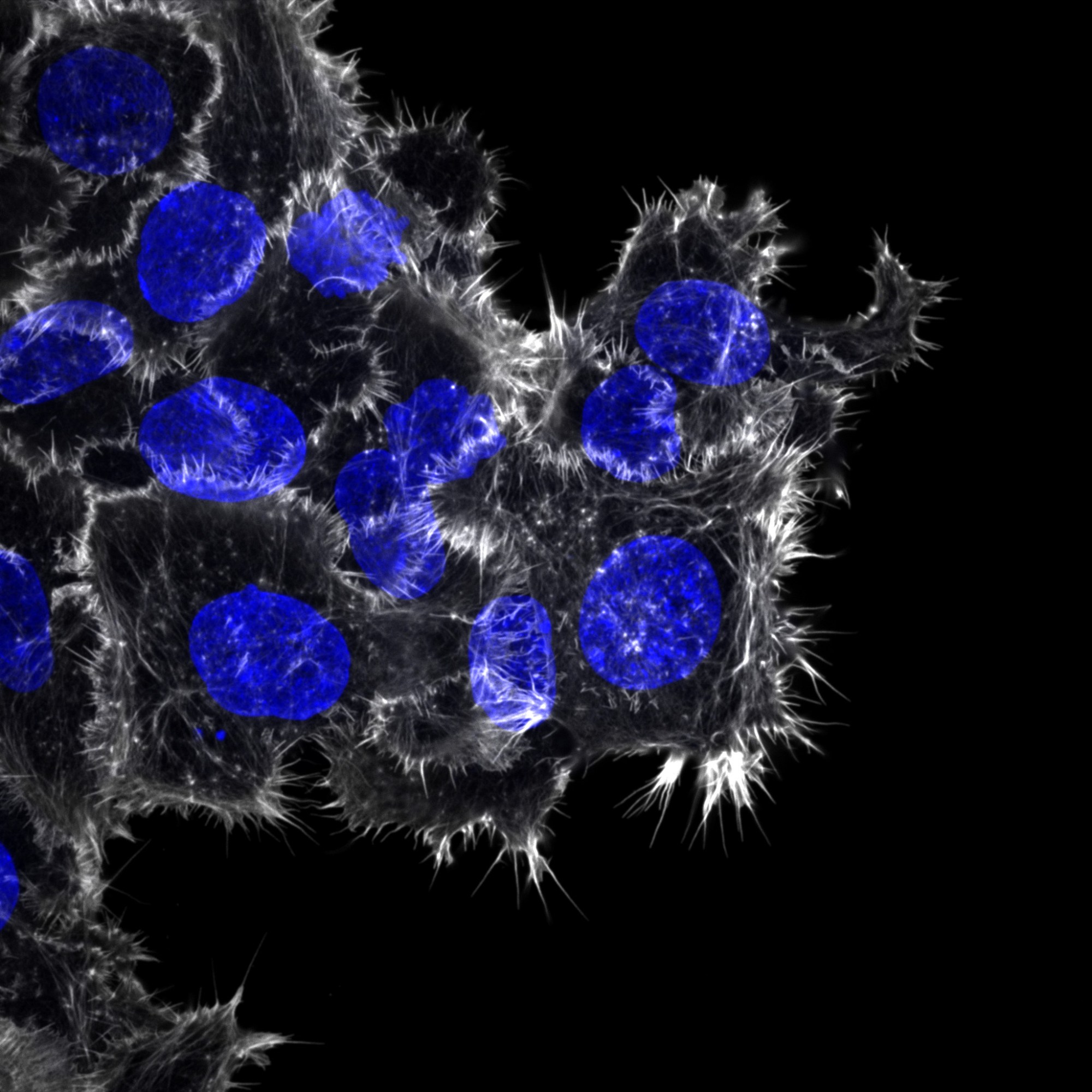 Breast cancer cells invading through collagen. The actin cytoskeleton (white) and the nuclei (blue) are labelled.